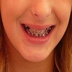 955161_braces_orthodontist